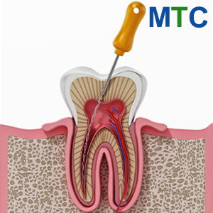 Root Canal Turkey