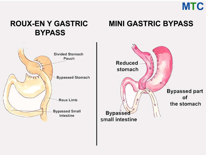 Gastric Bypass vs. Mini Gastric Bypass