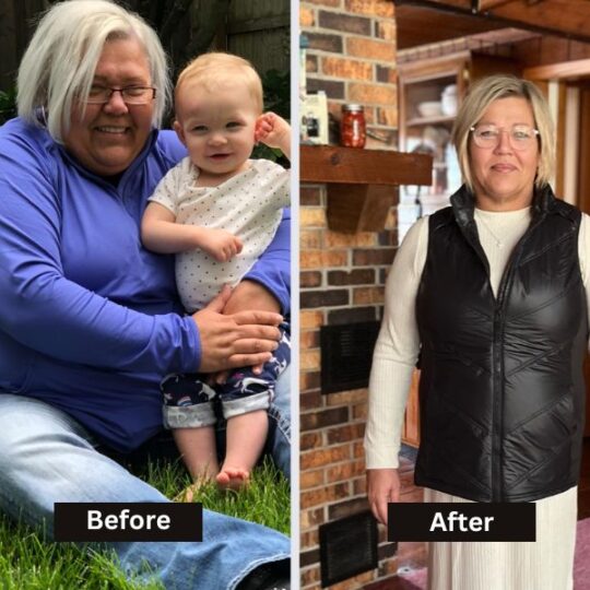 Before & After: Gastric Sleeve in Mexico