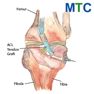 ACL Repair in Mexico