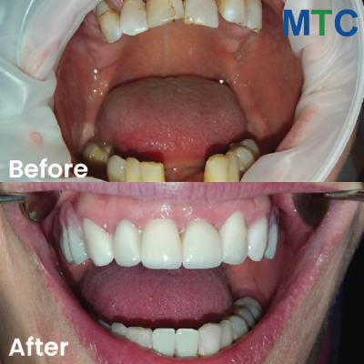 Before & After Dental Implants in Dubrovnik, Croatia