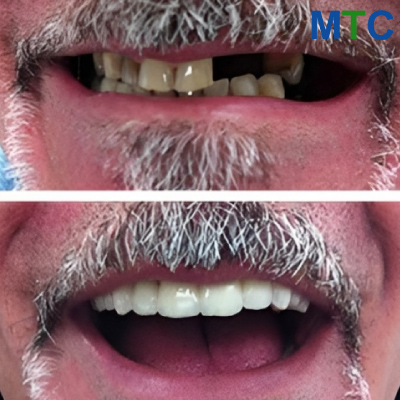 Before and After: Dental Implants in Zagreb