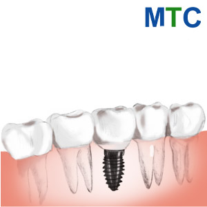 Endosteal Dental Implant