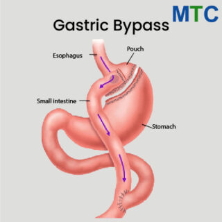 Gastric bypass in Turkey