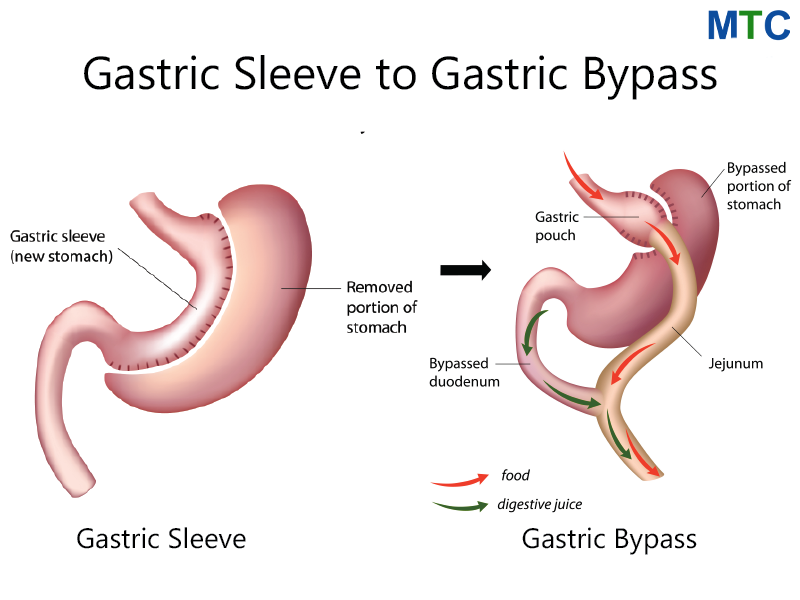 Gastric Sleeve to Gastric Bypass