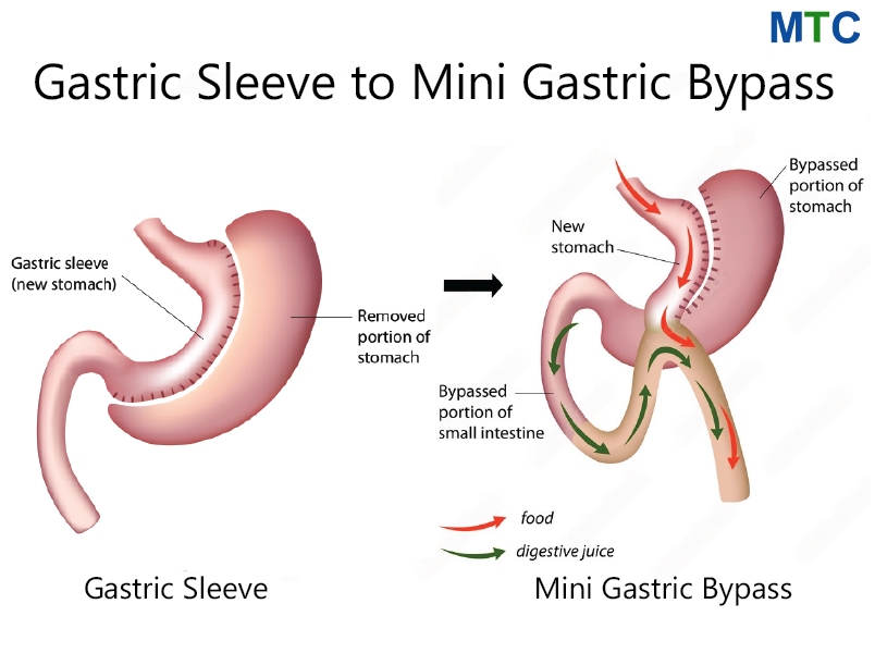Gastric Sleeve to Mini Gastric Bypass