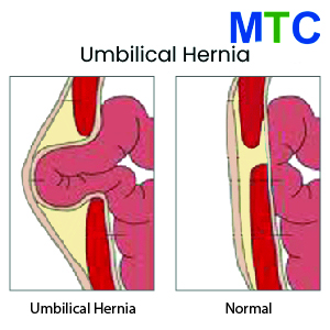 Umbilical Hernia Repair Los Algodones, Mexico