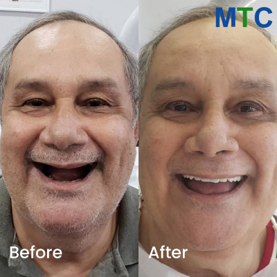 Before & After: All on 4 Implants in Brazil