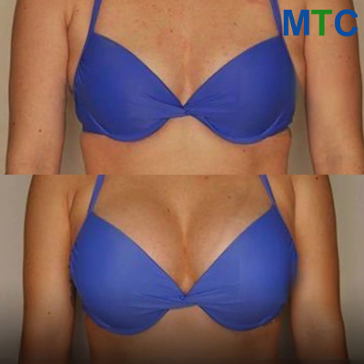 Before & After: Breast Augmentation in Turkey