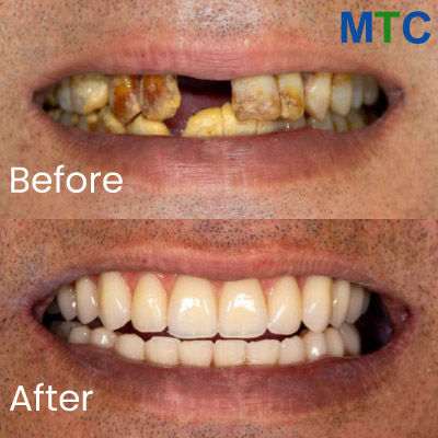Before & After: Dental Implants in Brazil