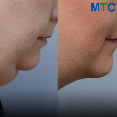 Before & After: Jawline Liposuction in Turkey