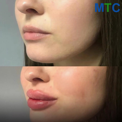Before & After: Lip Filler in Turkey