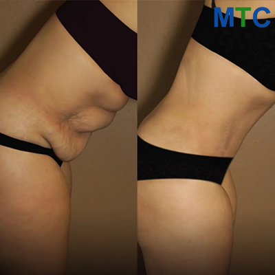 Before & After: Tummy Tuck in Turkey