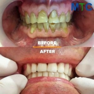Before and After Smile Makeovers in Split, Croatia