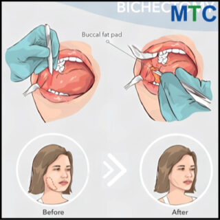 Bichectomy