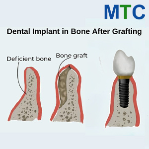Bone Graft for Dental Implants