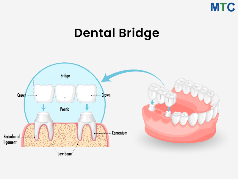 Anatomy of Dental Bridge | Dentures in Los Algodones