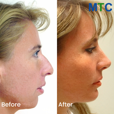 Rhinoplasty in Cancun | Before & After