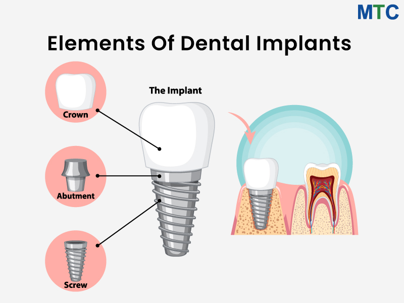 Parts of Dental Implant