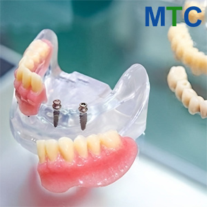 Mini dental implants in Cancun