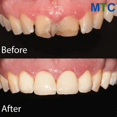 Zadar Dental Work Before & After