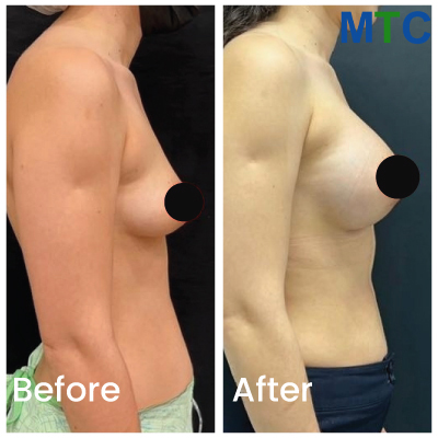 Before/After Breast Augmentation