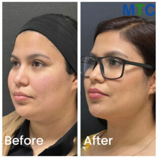 Before/After Chin Liposuction