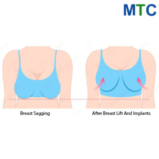 Breast Lifting & Implants