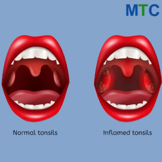 Inflamed tonsils for Tonsillectomy