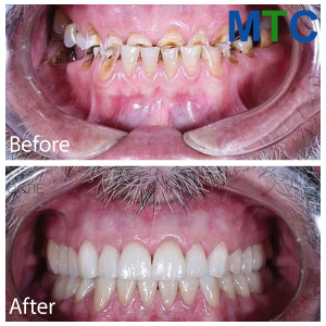 Before| After Dental Implants in Istanbul, Turkey