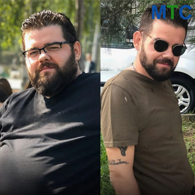 Before & After: Gastric Sleeve in Turkey