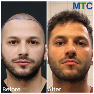 Hair Transplant in Istanbul Turkey | Before & After