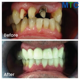 Dental implants in Crete - Before & After