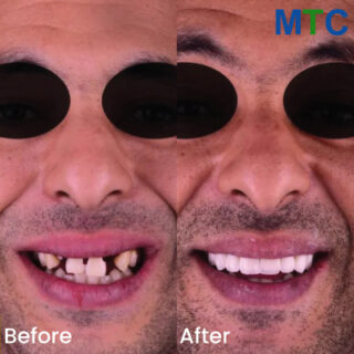 Full moith dental implants - Before and After