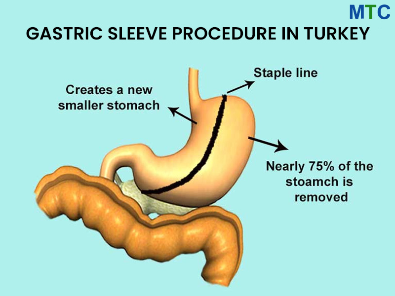 Gastric Sleeve Procedure in Turkey