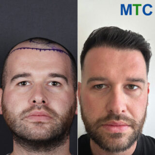 Hair Transplant in Istanbul, Turkey: Before & After