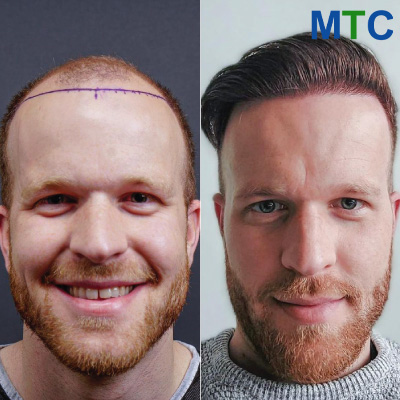 Before After Hair Transplant in Turkey