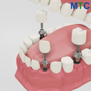 Multiple Teeth Dental Implant in Guatemala City