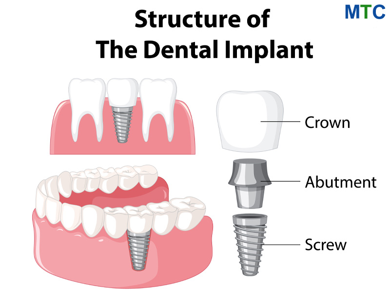 Structure od dental implant