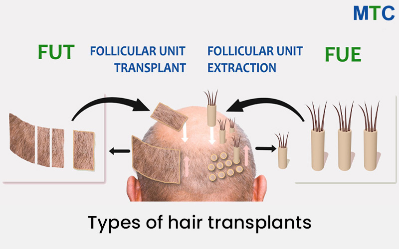 Types of Hair Transplants