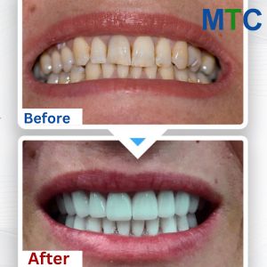 Before and After Getting Veneers in Istanbul