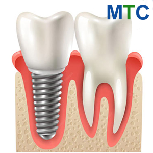 Implant vs. Natural Tooth