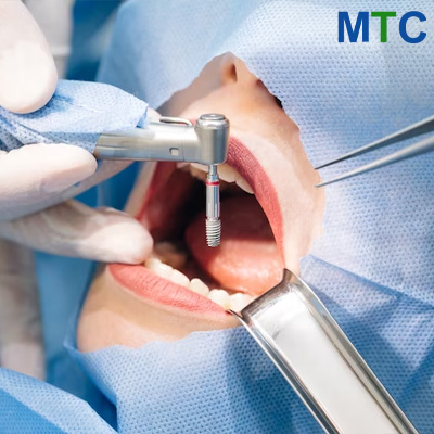 Dental implant procedure in Crete, Greece
