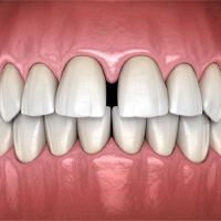 Spaces between teeth