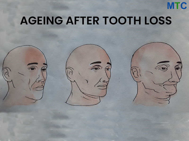 Ageing after tooth loss
