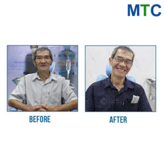 Full mouth dental implants in Vietnam - Before & After