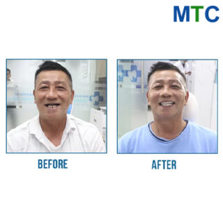 All on 6 dental implants in Vietnam - Before & After