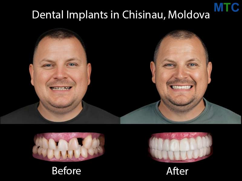 Dental implants in Chisinau, Moldova - Before & After