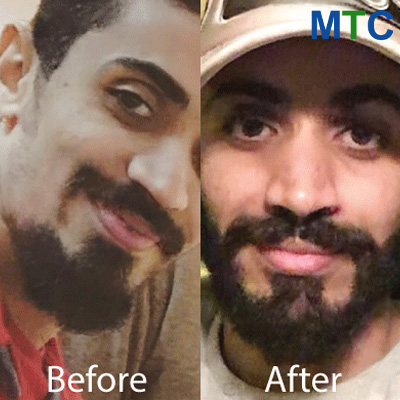 Before & After | Beard Transplant Turkey