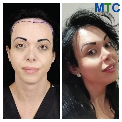 Before & After Hair Transplant for Women in Turkey
